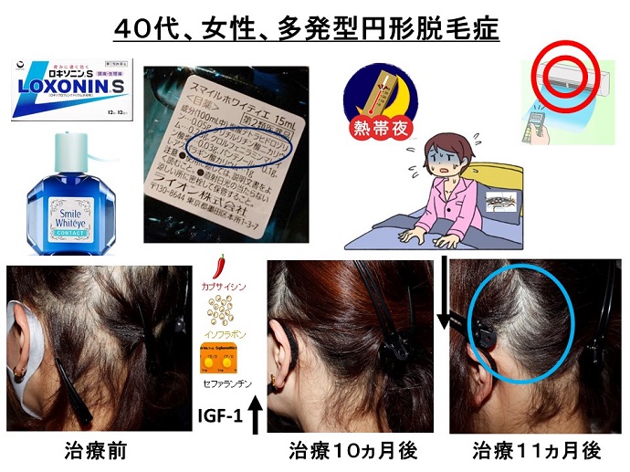 円形脱毛症　病院